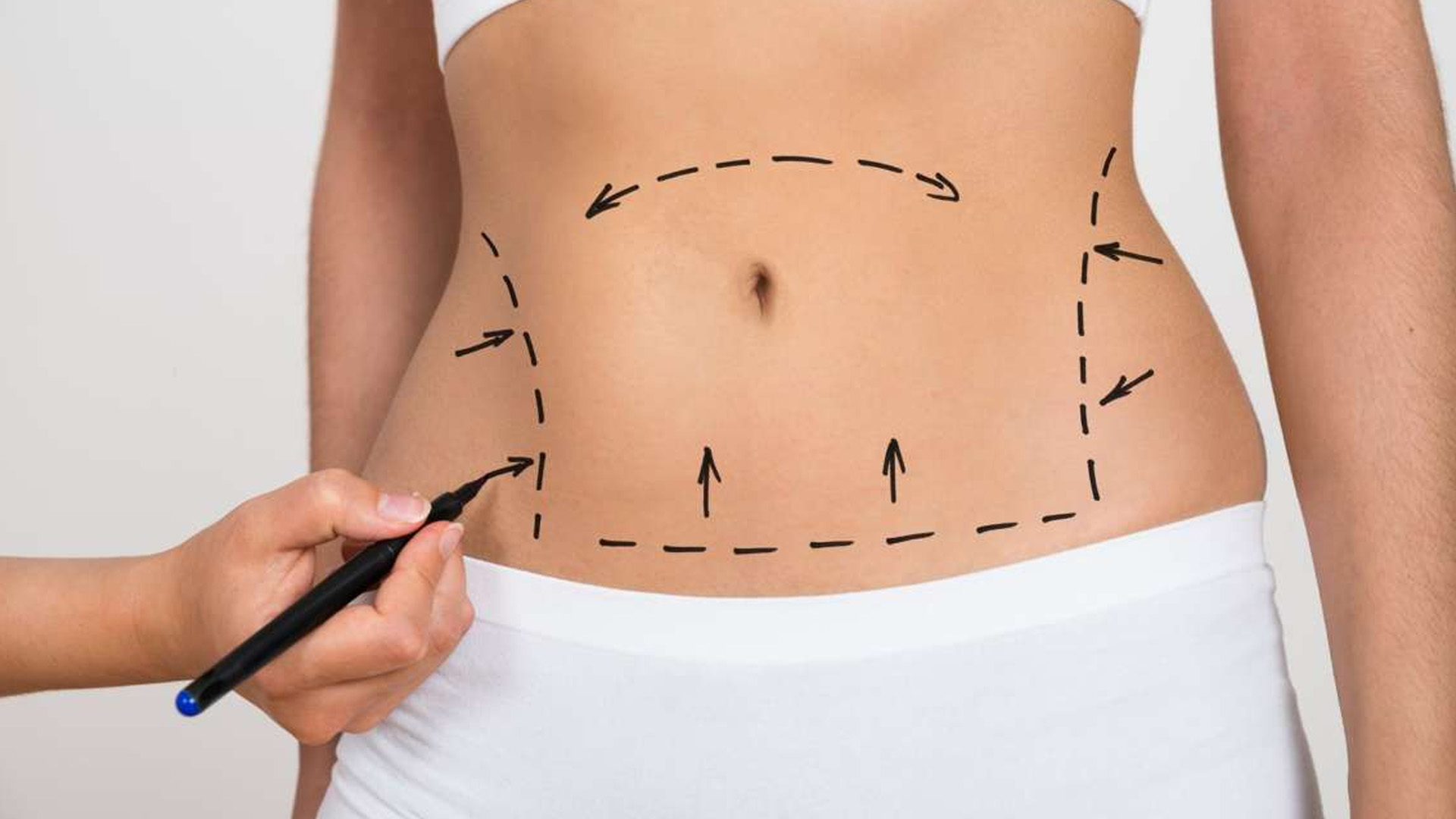 Abdominaplasty | Cosmoarts Clinic