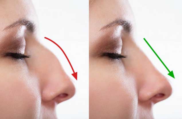 What are the factors you need to understand about nose surgery before and after?