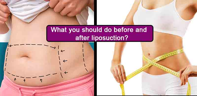 What you should do before and after liposuction?