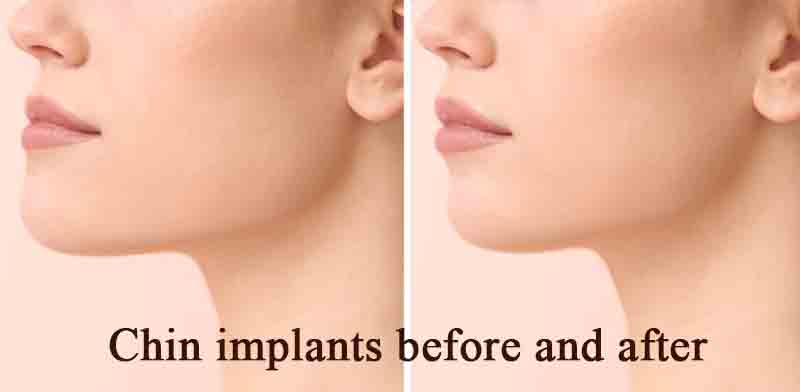chin implants before and after