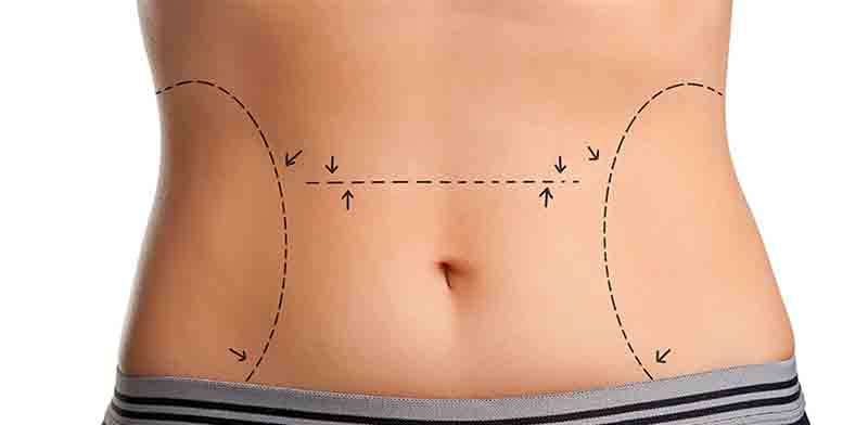 What is liposuction