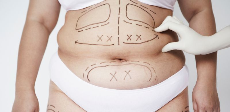 How much weight can you lose with liposuction?