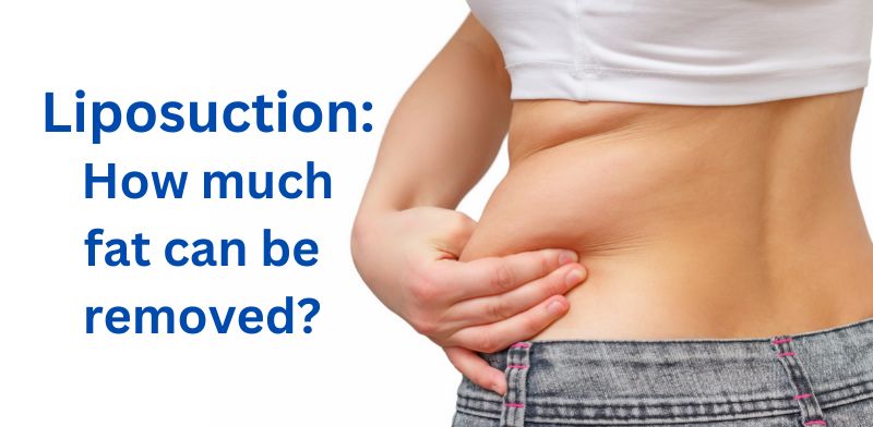Liposuction: How much fat can be removed?