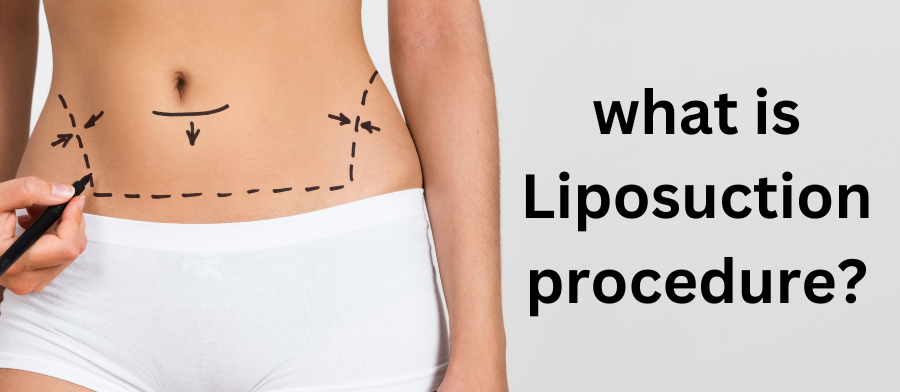 What is liposuction and how does it function?