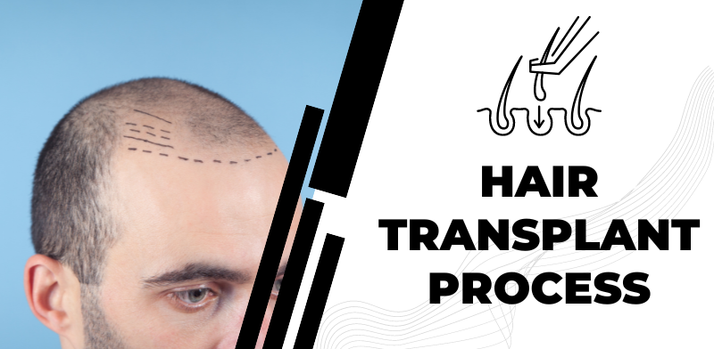 What is the benefit of the hair transplant process?