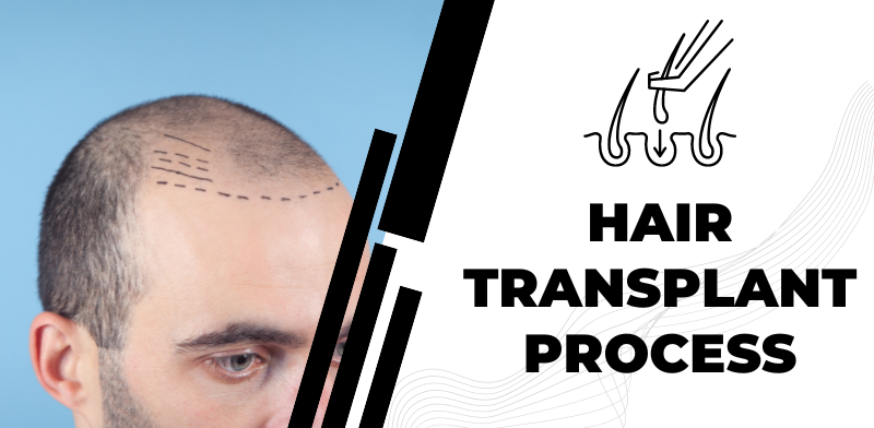 hair transplant process