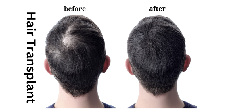 What is the result of a hair transplant before and after?