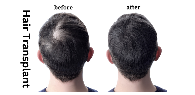 hair transplant before and after