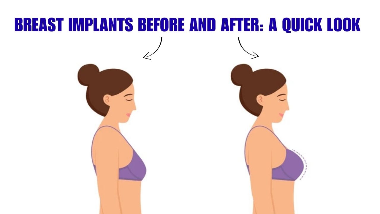Breast Implants before and after: A quick look