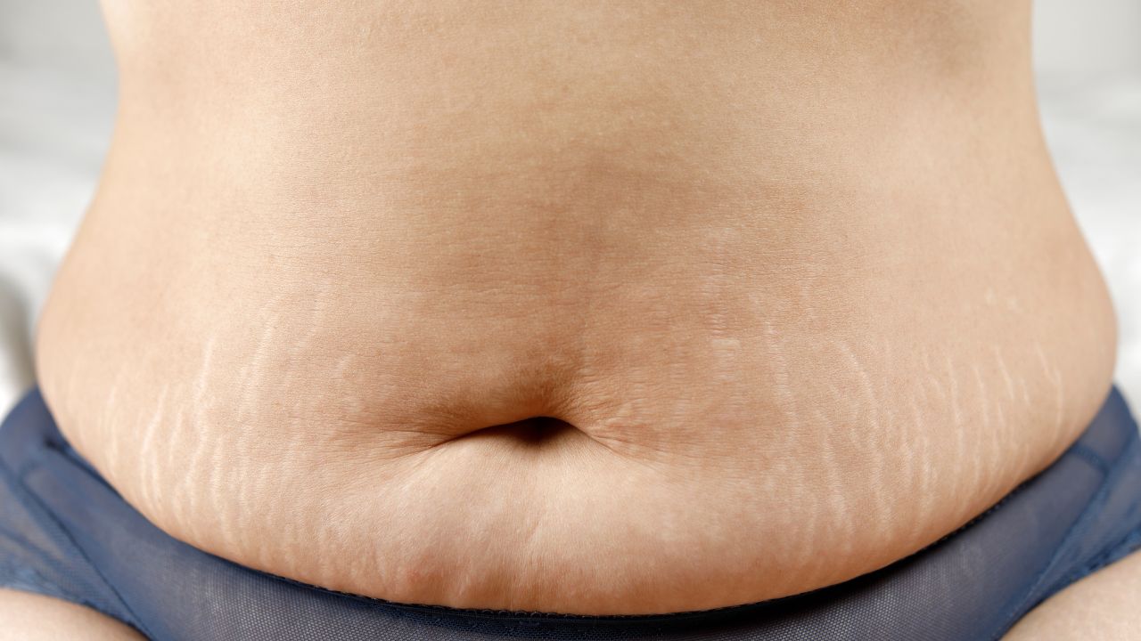Can tummy tuck remove stretch marks: an inside story
