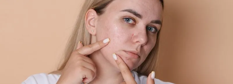 Acne scar treatment at Cosmo Arts Clinic Kolkata