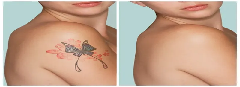 Laser tattoo removal