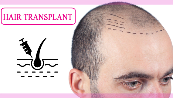 Hair Transplant Clinic - Cosmo Arts Clinic
