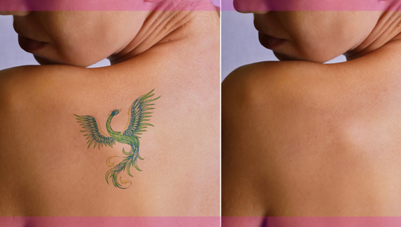 Laser tattoo removal kolkata | tattoo removal clinic in kolkata - Cosmo Arts Clinic
