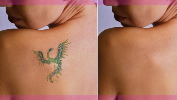 Laser Tatto Removal - Cosmo Arts Clinic