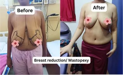 Breast reduction surgery before and after in Kolkata | Reduction mammoplasty results Cosmo Arts Clinic