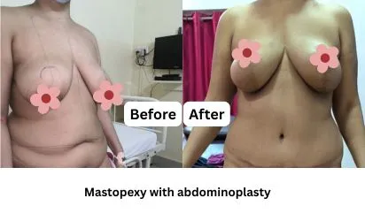 Mastopexy with abdominoplasty before and after in Kolkata | Breast lift and tummy tuck Cosmo Arts Clinic