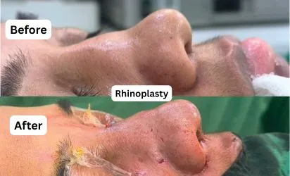 Rhinoplasty before and after results in Kolkata | Nose reshaping surgery Cosmo Arts Clinic