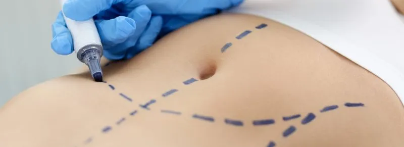 Abdominoplasty treatment at Cosmo Arts Clinic Kolkata