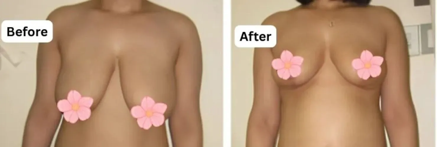 Before and after breast reduction surgery in Kolkata